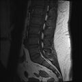 Normal lumbar spine MRI (Radiopaedia 47857-52609 Sagittal T1 9).jpg