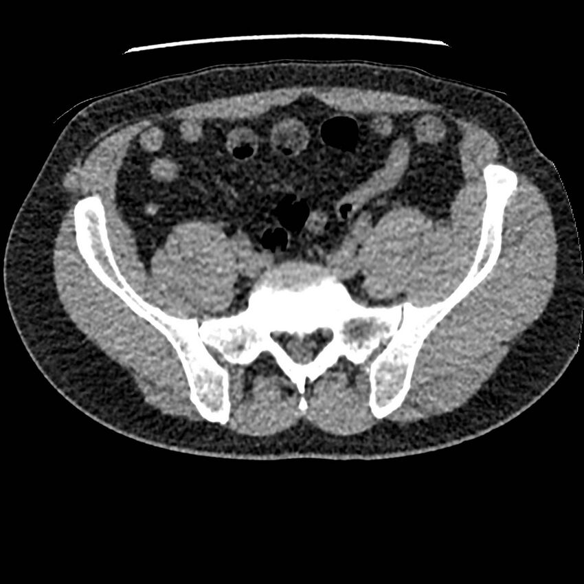 Obstructing ureteric calculus and ureteric anatomy (Radiopaedia 62730-71042 Axial non-contrast 114).jpg