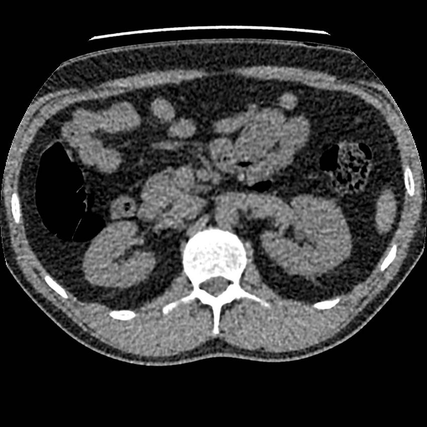 Obstructing ureteric calculus and ureteric anatomy (Radiopaedia 62730-71042 Axial non-contrast 34).jpg
