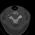 Occipital condyle fracture (Radiopaedia 31755-32691 Axial bone window 26).jpg