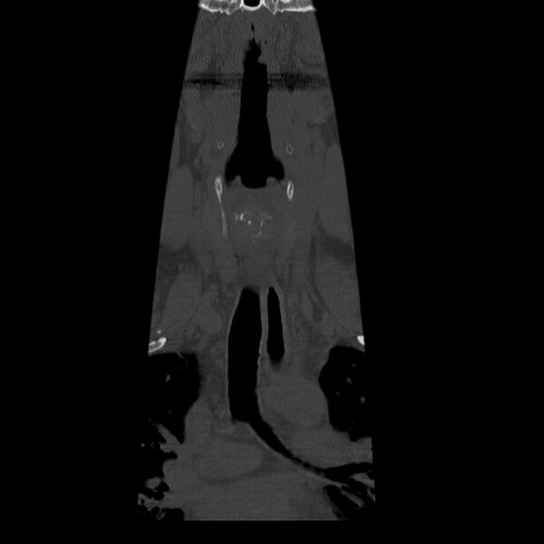 File:Occipital condyle fracture (Radiopaedia 31755-32691 Coronal bone window 2).jpg