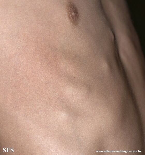 File:Osteochondroma (Dermatology Atlas 9).jpg