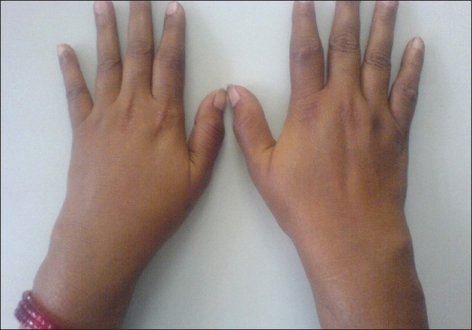 Symmetrical inflammatory polyarthritis of the small joints of the hands and tenosynovitis of the wrist joints in a patient with chronic stage of Chikungunya fever
