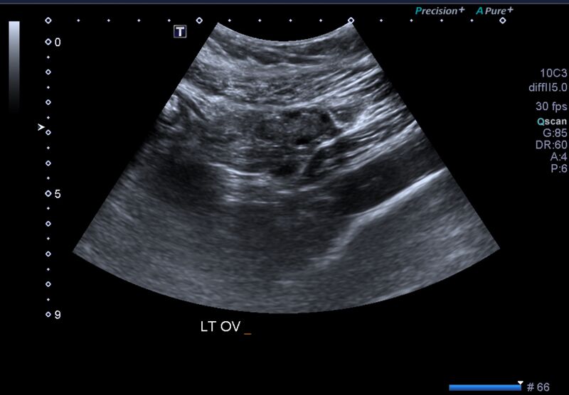 File:1st trimester nuchal-morphology ultrasound (Radiopaedia 44706-48477 General anatomy and NT 51).jpg