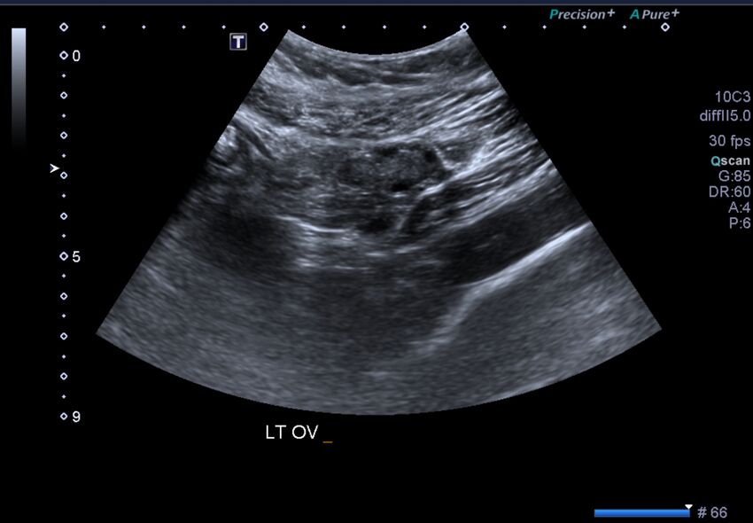 1st trimester nuchal-morphology ultrasound (Radiopaedia 44706-48477 General anatomy and NT 51).jpg