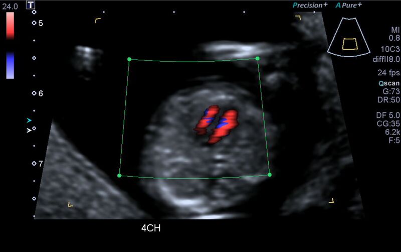 File:1st trimester nuchal-morphology ultrasound (Radiopaedia 44706-48477 Heart views cine with colour 30).jpg