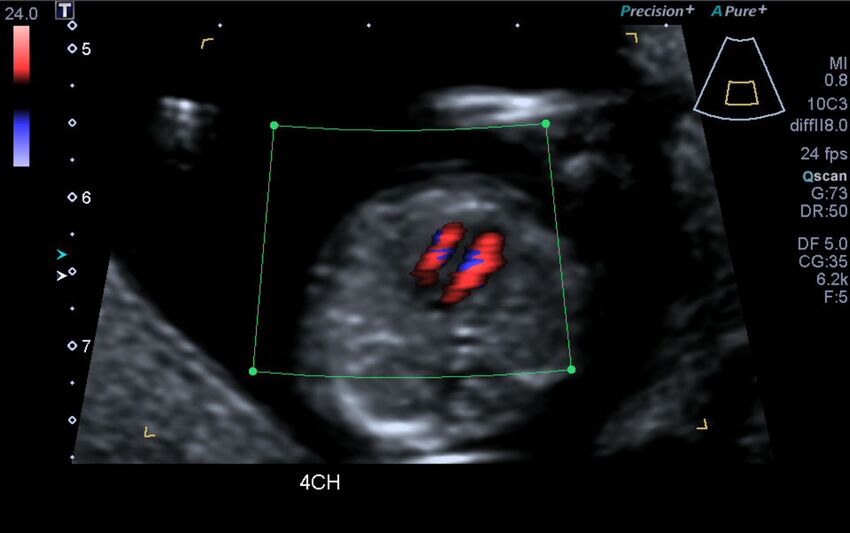 1st trimester nuchal-morphology ultrasound (Radiopaedia 44706-48477 Heart views cine with colour 30).jpg