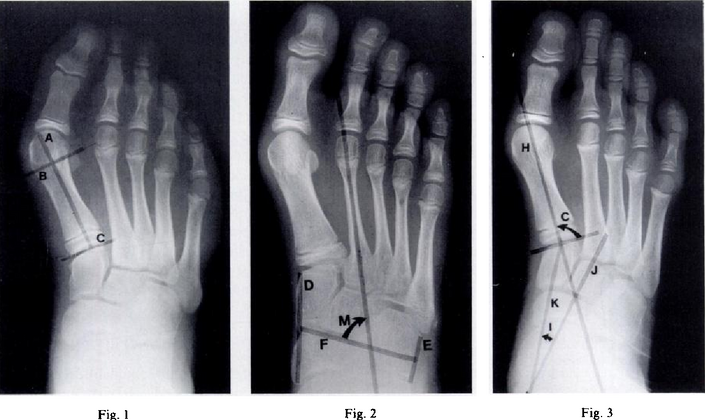Metatarsus (primus) varus-Fig 1 - Length of the lateral cortex of the first metatarsal, Fig 2-metatarsus adductus angle measures the position of the lesser tarsus relative to the midfoot, Fig 3- the cuneiform angle