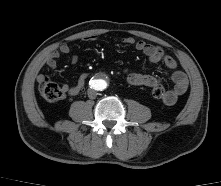 File:Abdominal aortic aneurysm (Radiopaedia 22421-22458 C+ arterial phase 54).jpg