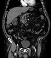 Abdominal aortic aneurysm (Radiopaedia 25855-26001 Coronal C+ arterial phase 16).jpg