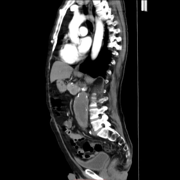 File:Abdominal aortic interposition tube graft and aneurysm thrombosis (Radiopaedia 71438-81857 Sagittal C+ arterial phase 14).jpg