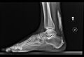 Achilles tendon ossification (Radiopaedia 46824).jpg