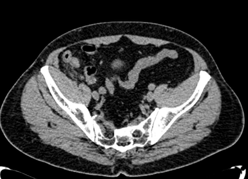 Acute appendicitis (Radiopaedia 13030-13091 Axial non-contrast 64).jpg