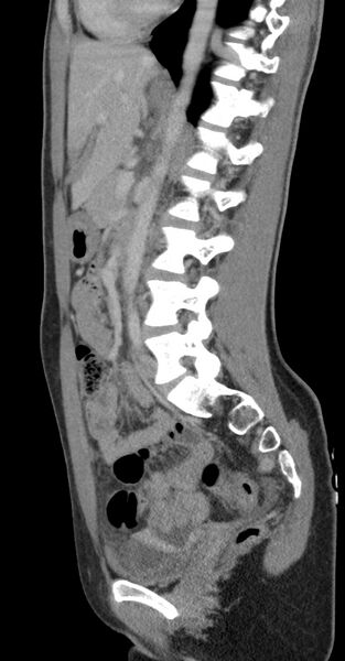 File:Acute appendicitis (Radiopaedia 62608-70901 Sagittal C+ portal venous phase 12).jpg