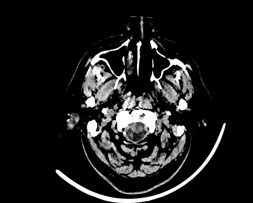 Acute cerebral infarct (Radiopaedia 35604-37123 Axial non-contrast 3).jpg