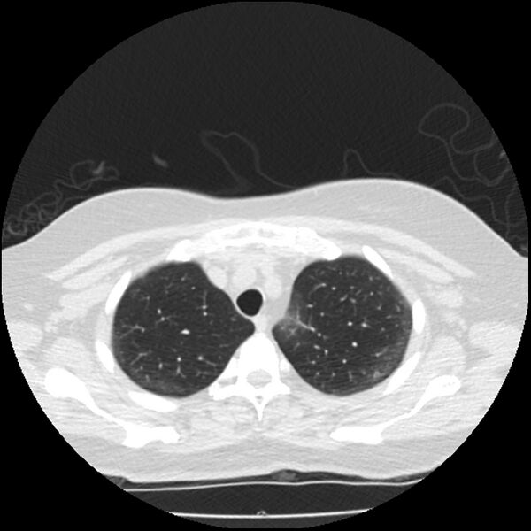 File:Acute interstitial pneumonitis (Radiopaedia 45404-49444 Axial lung window 20).jpg