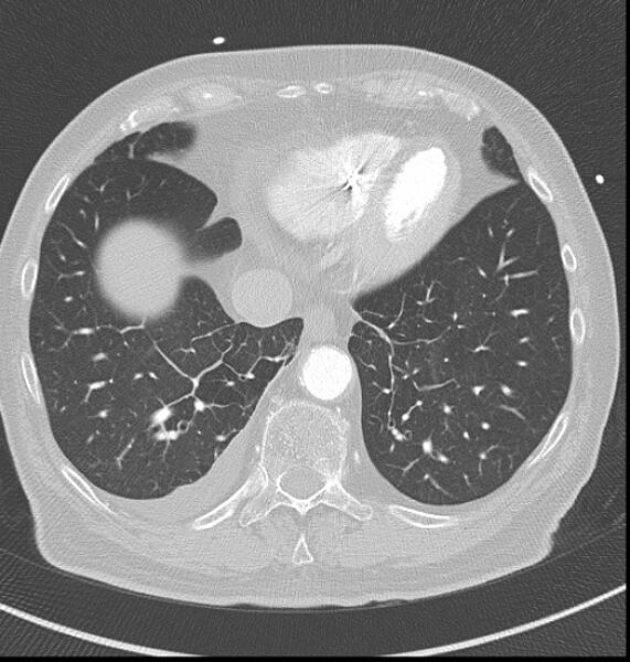 File:Acute myocardial infarction (Radiopaedia 23413-23481 lung window 57).jpg