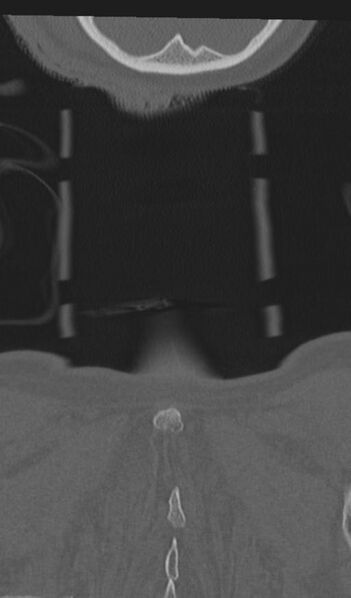 File:Acute on chronic subdural hematoma and thoracic vertebral injury in a multitrauma patient (Radiopaedia 31698-32619 Coronal bone window 76).jpg