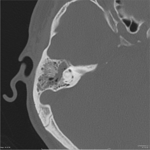File:Acute otomastoiditis (Radiopaedia 28276-28512 Axial PTB bone window reformat 29).jpg