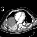 Acute pancreatic necrosis (Radiopaedia 13560-13486 Axial C+ portal venous phase 8).jpg