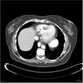 Acute pancreatitis (Radiopaedia 19136-19117 Axial C+ portal venous phase 1).jpg