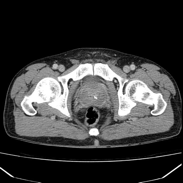 File:Acute pancreatitis (Radiopaedia 22572-22596 Axial C+ portal venous phase 72).jpg