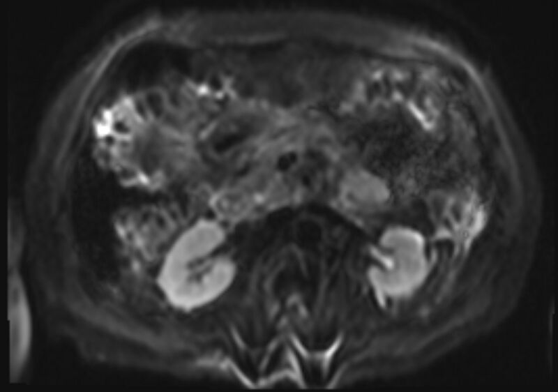 File:Acute portal vein thrombosis (Radiopaedia 73198-83925 Axial DWI 20).jpg