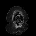 Acute pyelonephritis (Radiopaedia 25657-25837 Coronal renal parenchymal phase 15).jpg