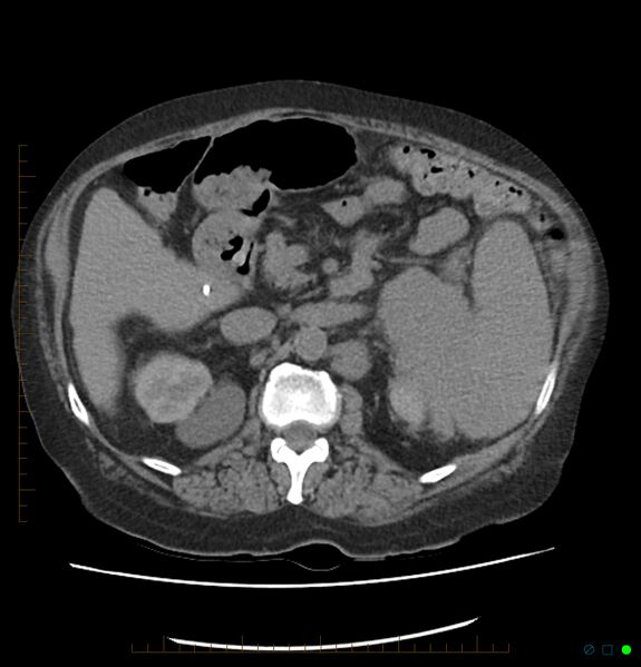 File:Acute renal failure post IV contrast injection- CT findings (Radiopaedia 47815-52557 Axial non-contrast 30).jpg