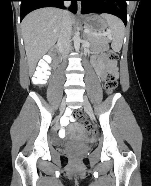 File:Acute uncomplicated appendicitis (Radiopaedia 61374-69304 Coronal C+ portal venous phase 58).jpg
