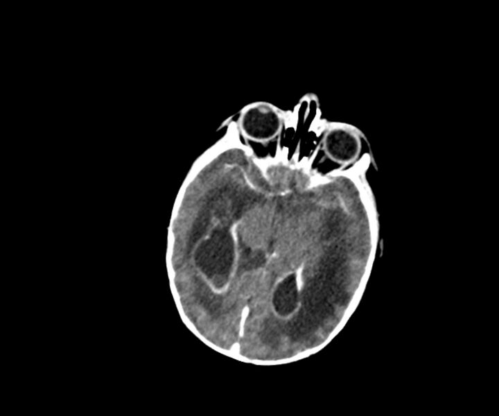 File:Acute ventriculitis (Radiopaedia 57502-64459 Axial +contrast 8).jpg