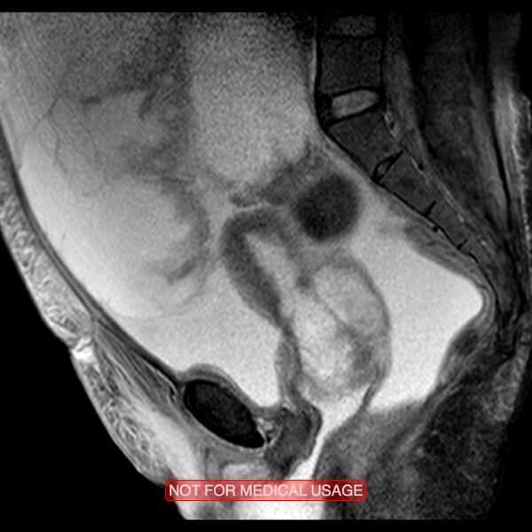 File:Adenocarcinoma of the cervix (Radiopaedia 28373-28615 Sagittal T2 fat sat 9).jpg