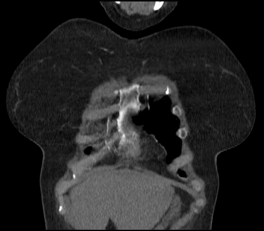 Adenocarcinoma of the lung (Radiopaedia 44205-47803 Coronal C+ portal venous phase 9).jpg