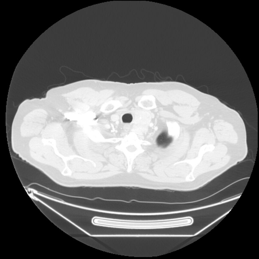 Adenocarcinoma of the lung (Radiopaedia 44876-48759 Axial lung window 2).jpg