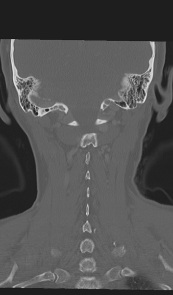 File:Adenoid cystic tumor of palate (Radiopaedia 46980-51518 Coronal bone window 48).png