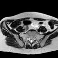 Adenomyoma of the uterus (huge) (Radiopaedia 9870-10438 Axial T2 34).jpg
