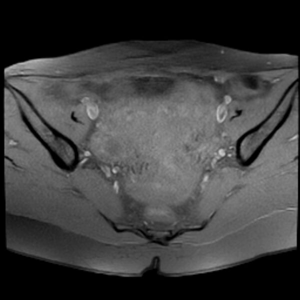 File:Adenomyosis within a septate uterus (Radiopaedia 69963-79981 Axial T1 fat sat 14).jpg