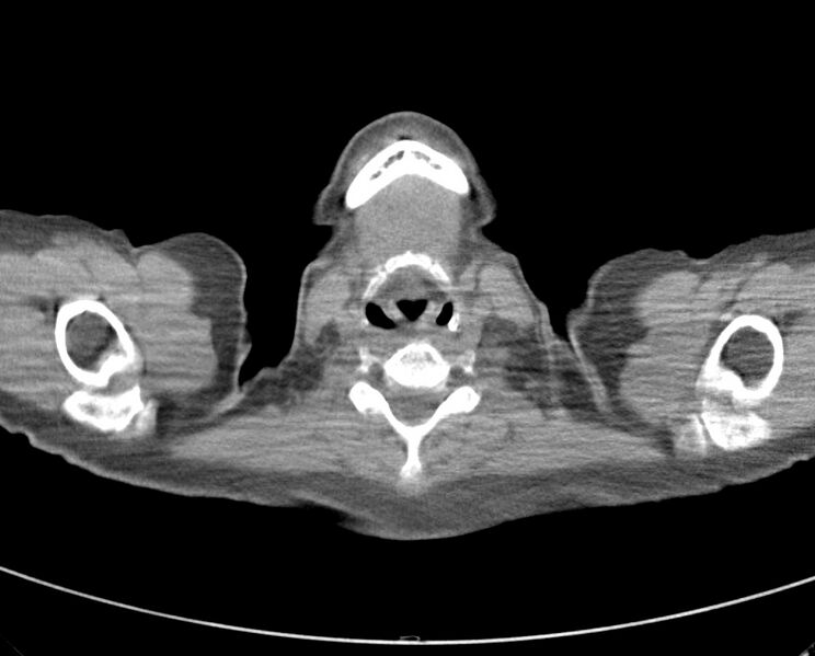 File:Adenosquamous lung carcinoma (Radiopaedia 22035-22030 non-contrast 4).jpg