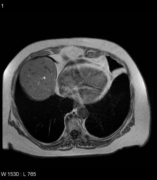 File:Adrenal myelolipoma (Radiopaedia 6765-7961 Axial T1 in-phase 1).jpg