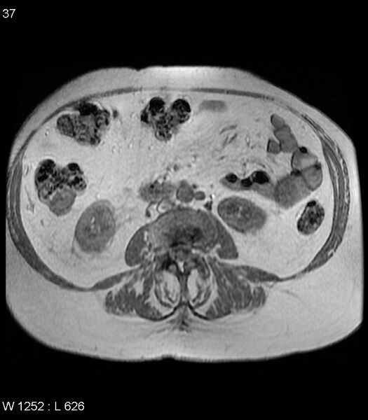 File:Adrenal myelolipoma (Radiopaedia 6765-7961 Axial T1 in-phase 37).jpg