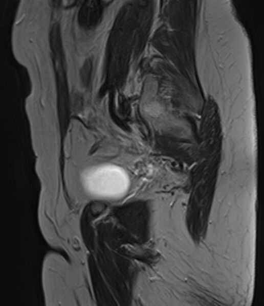 File:Adult granulosa cell tumor of the ovary (Radiopaedia 71581-81950 Sagittal T2 18).jpg