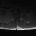 Aggressive vertebral hemangioma (Radiopaedia 39937-42404 Axial T1 7).png