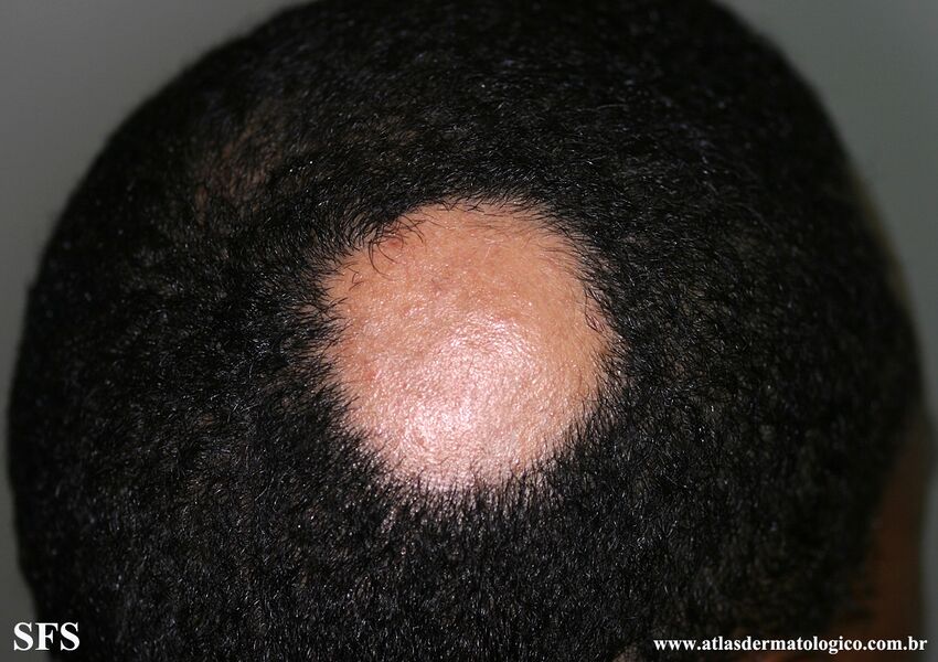 Alopecia Areata (Dermatology Atlas 70).jpg