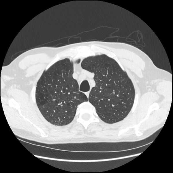File:Alpha-1-antitrypsin deficiency (Radiopaedia 40993-43722 Axial lung window 38).jpg