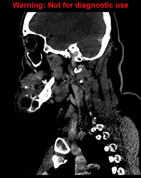 File:Ameloblastoma (Radiopaedia 33126-34164 F 48).jpg