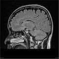 Amnestic syndrome secondary to hypoxic brain injury (Radiopaedia 24743-25004 D 5).jpg