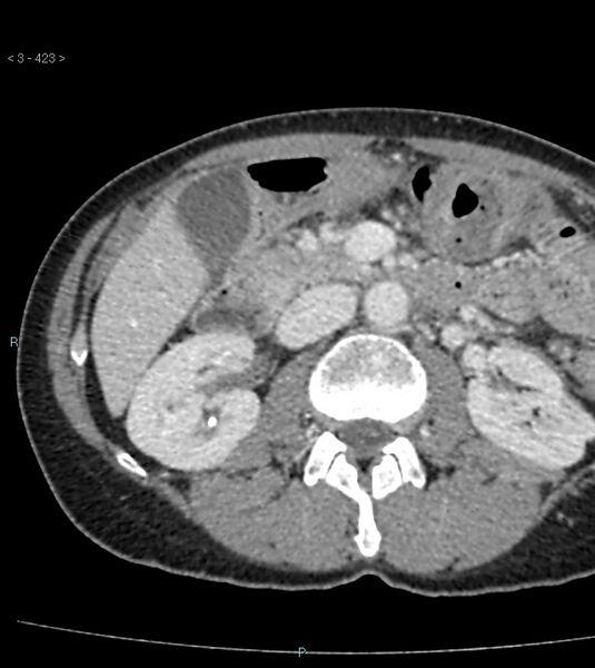 File:Ampulla of Vater metastasis (Radiopaedia 27820-28065 A 27).jpg