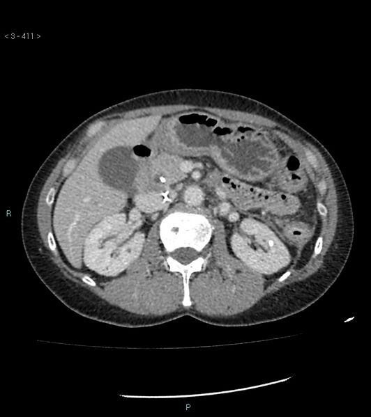 File:Ampulla of Vater metastasis (Radiopaedia 27820-28069 A 49).jpg