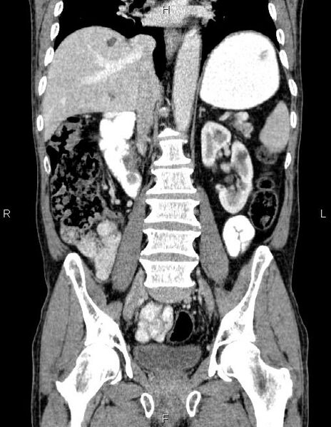 File:Ampullary adenocarcinoma (Radiopaedia 86093-102032 C 40).jpg