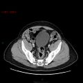 Ampullary carcinoma (Radiopaedia 56396-63056 C 83).jpg